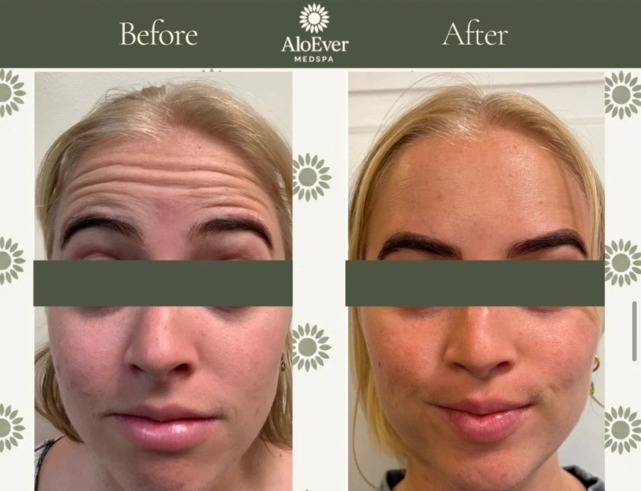 Botox before and after at AloEver Medspa Longwood FL