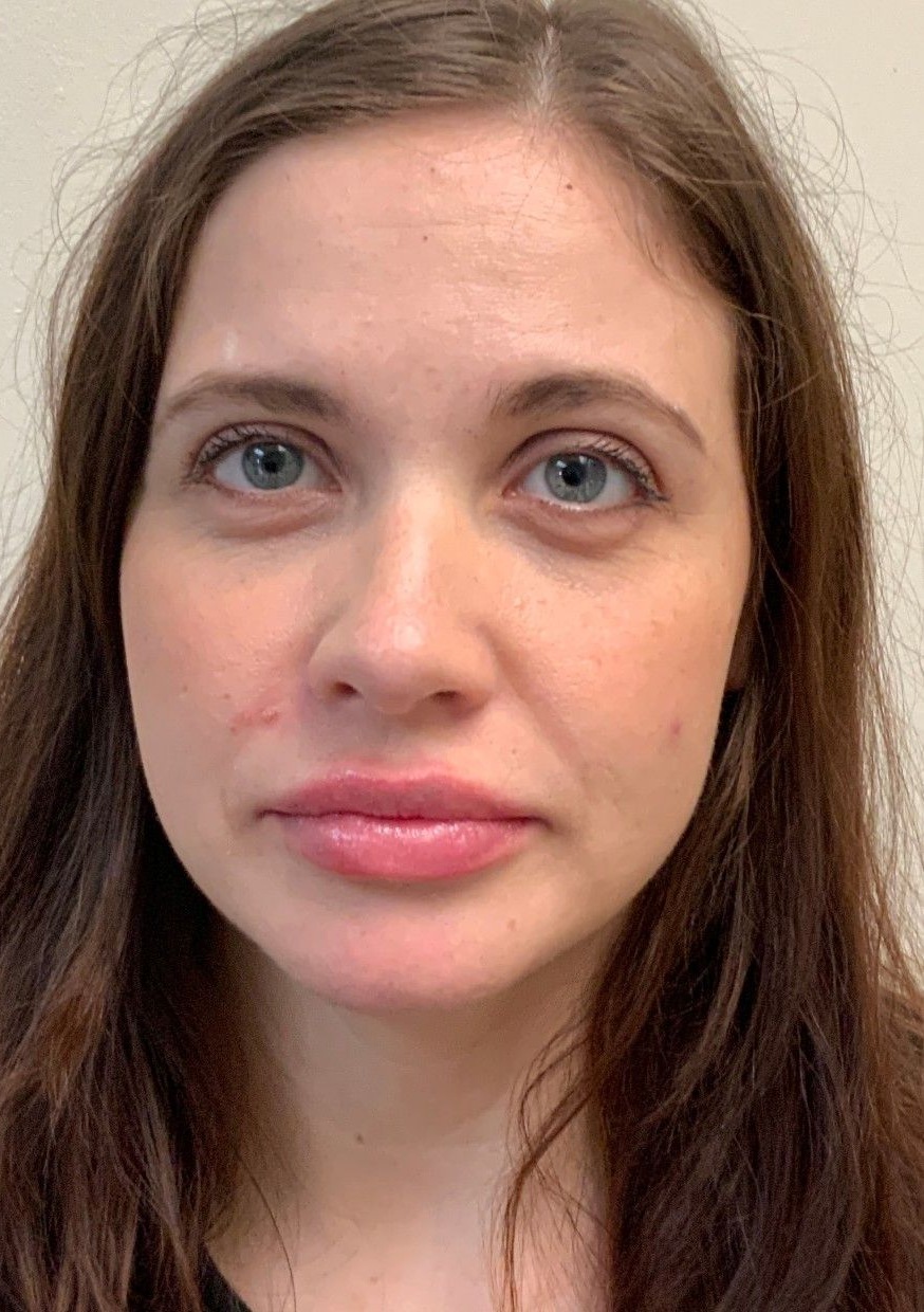 Lip filler after at AloEver Medspa