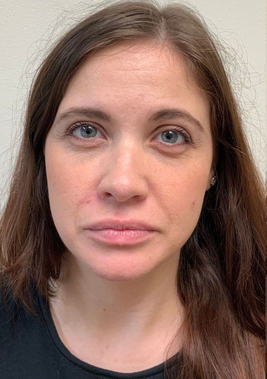 Lip filler before at AloEver Medspa