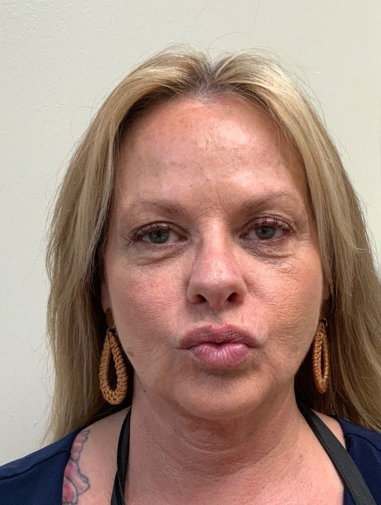 After Botox and filler treatment at AloEver Medspa Longwood FL