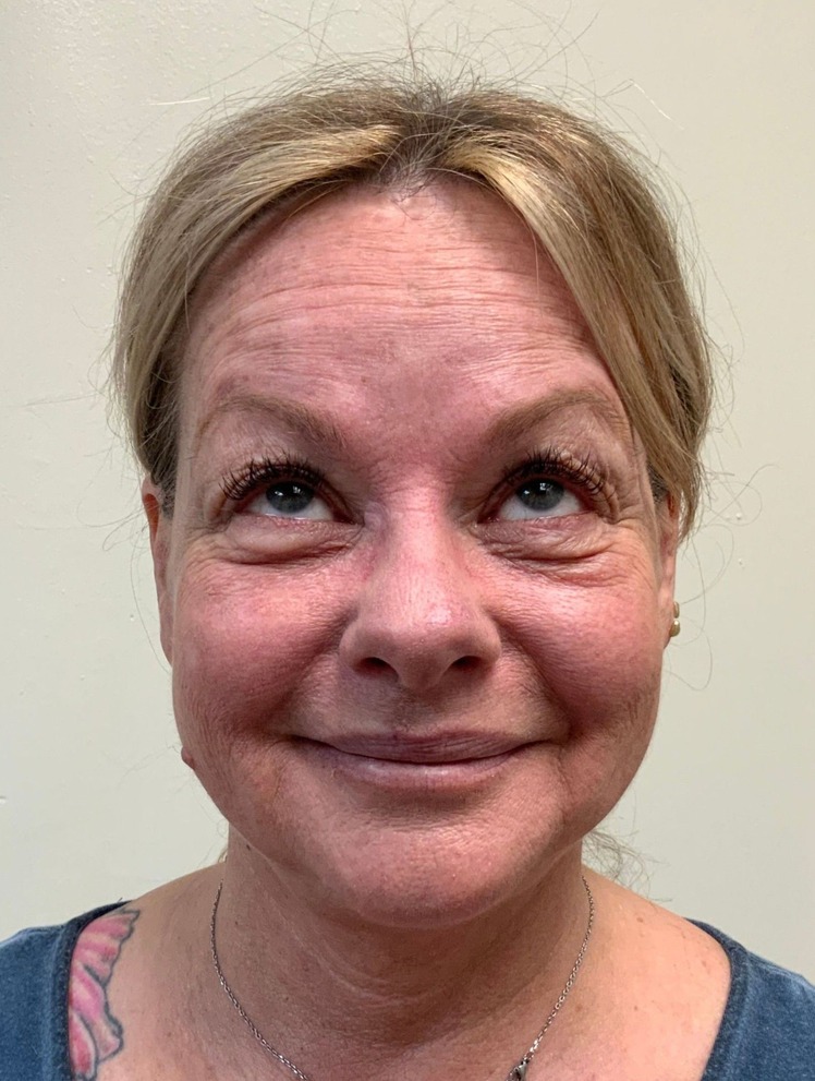 Before Botox and filler treatment at AloEver Medspa Longwood FL