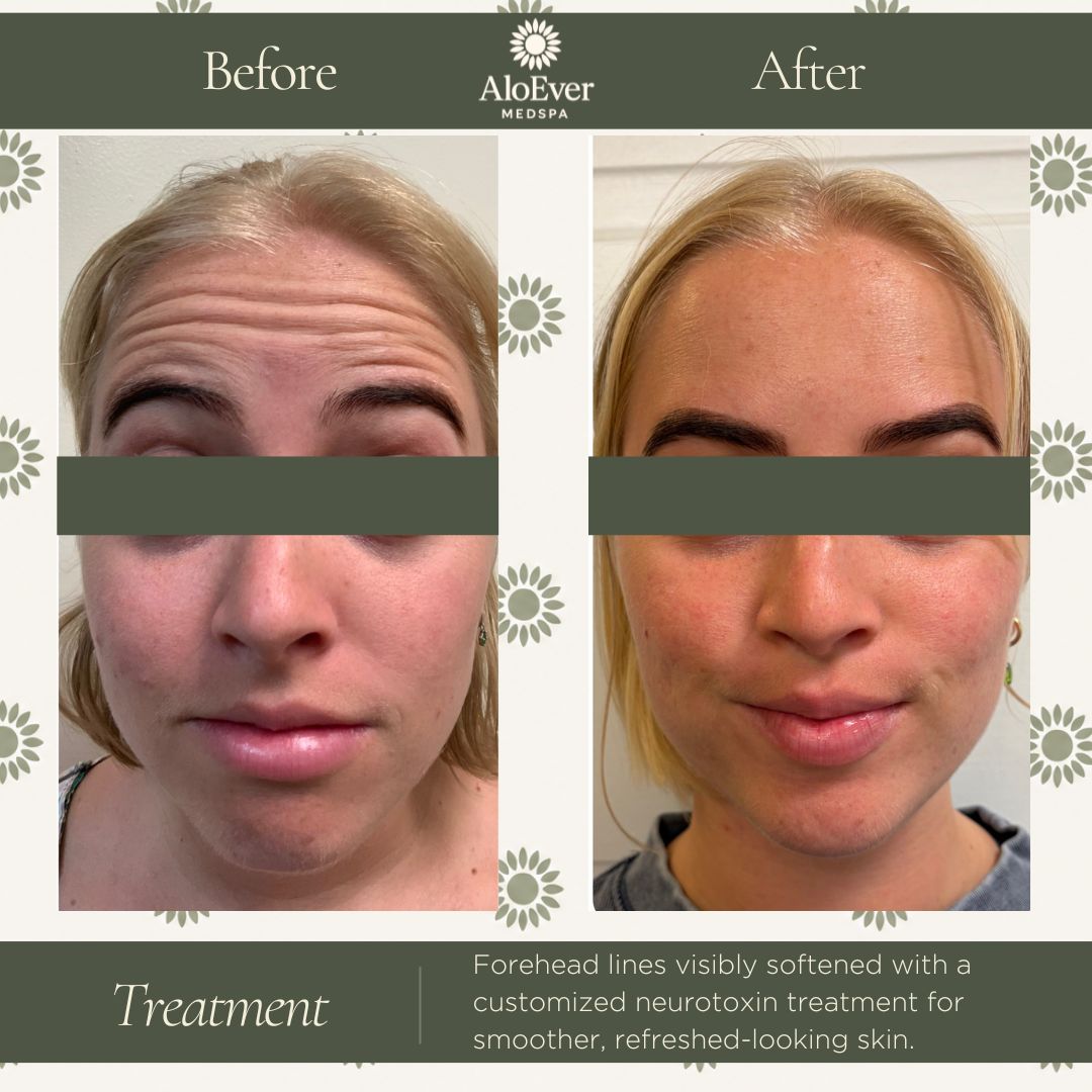 Neurotoxin before and after AloEver Medspa