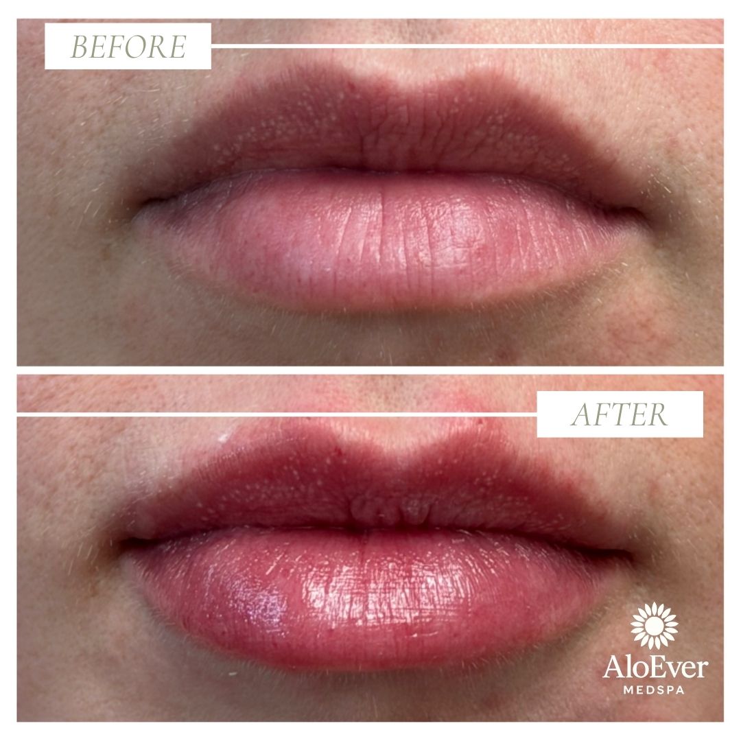 Lip filler before and after AloEver Medspa